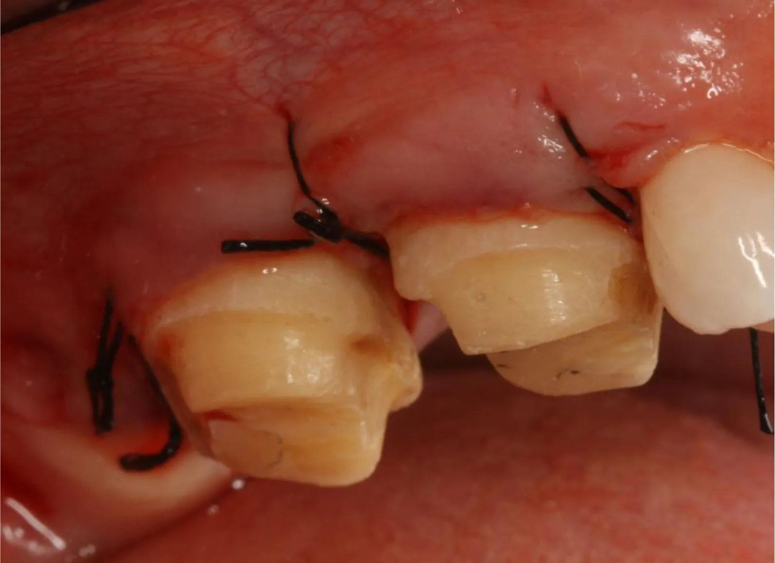 Crown Lengthening Periodontist 1751