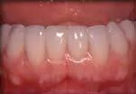After Straightened Teeth Without Braces Testimonial