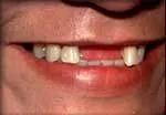 Before Partial Denture Smile (Testimonial)