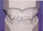 Overbite - Orthodontics