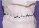Crossbite - Occlusion - Dentist in Huntsville, AL