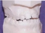 Crossbite - Occlusion - Orthodontist in Dallas, TX