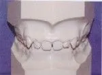 Overbite - Occlusion - Orthodontist in Dallas, TX