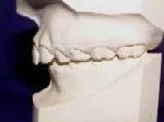 Class II - Malocclusion - Orthodontist in Dallas, TX