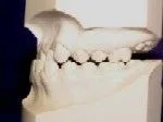 Class III - Malocclusion - Orthodontist in Dallas, TX