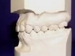 Class I - Malocclusion - Dentist in Huntsville, AL