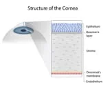 Corneal Consultation and Surgical Co-Management