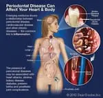 Periodontal Disease Can Affect Your Heart and Body Tampa, FL