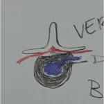 "Disc Herniation"