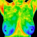 Thermography Breast Scan