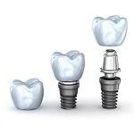 dental-implant