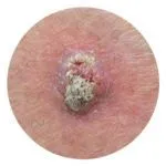 Squamous Cell Carcinoma