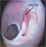Polyd in colon