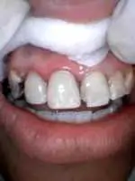 after photo of the teeth completely rebuilt using fiber posts and white filling material and custom staining