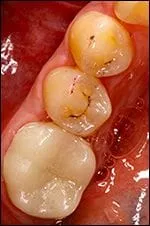inside of mouth showing back tooth after metal filling removed, replaced with dental crown New Baltimore, MI dentist