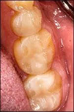 close up inside mouth of three teeth after metal fillings were replaced with tooth colored fillings New Baltimore, MI dentist