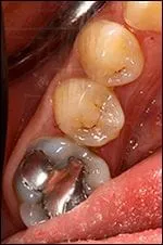 inside mouth showing back teeth, one tooth has deep metal filling, dentist New Baltimore, MI