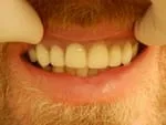 After Immediate Dentures