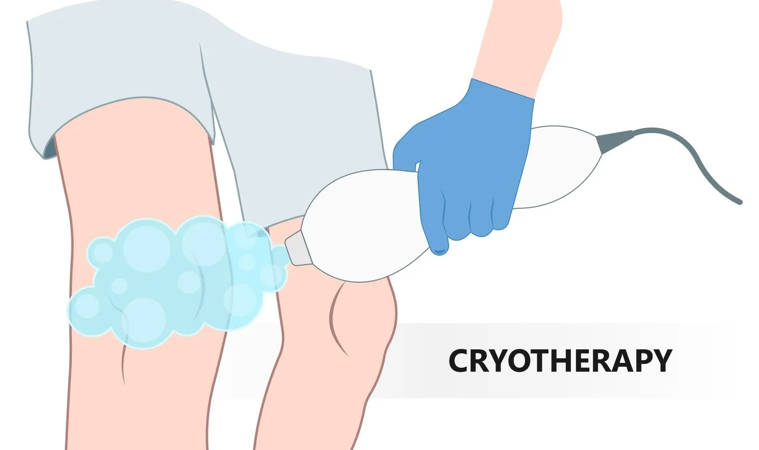 cryotherapy