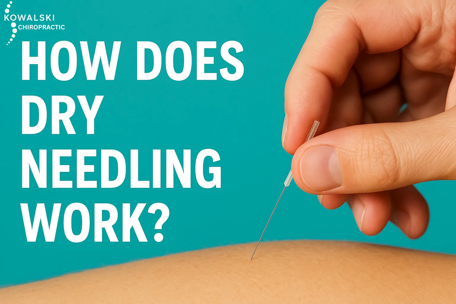 Dry Needling