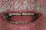 man's mouth smiling showing after results of cosmetic dentistry treatments from dentist Adelaide, SA