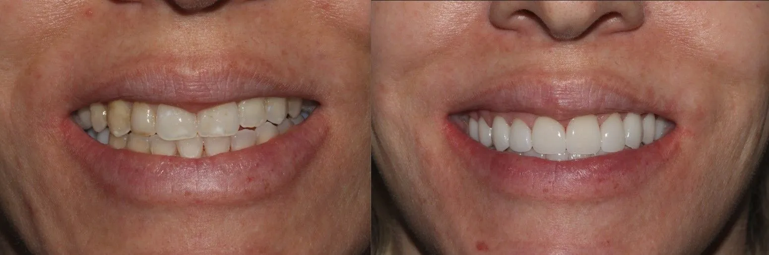 Smile Makeover