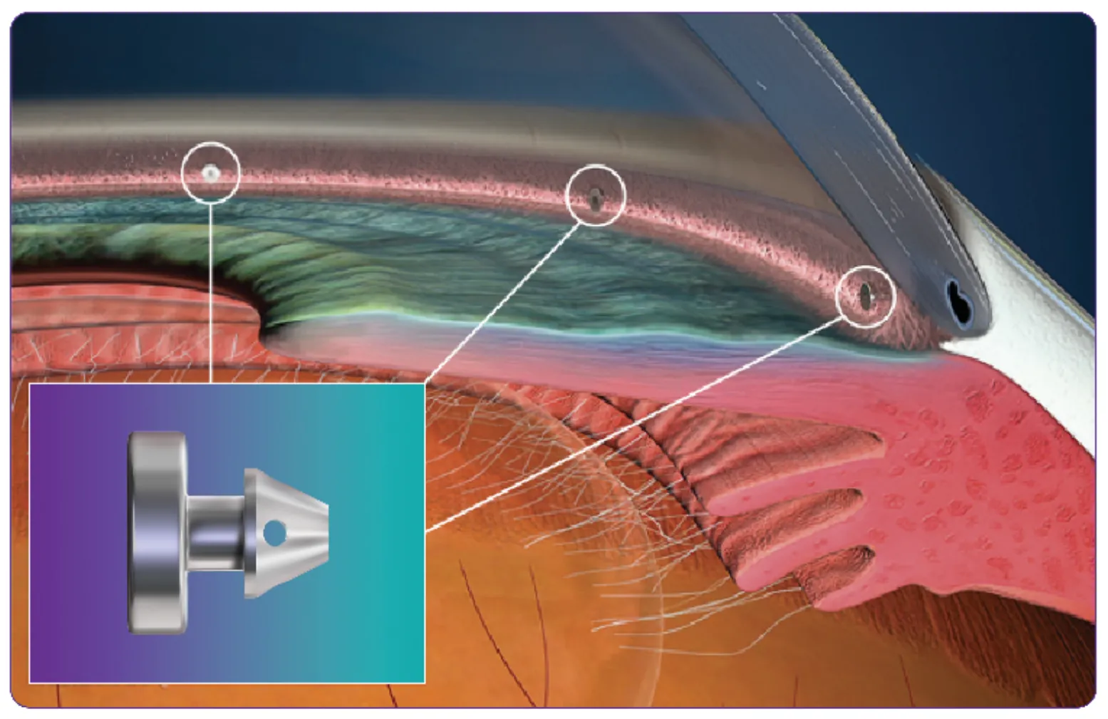 Istent-idose-glaucoma-migs-phoenix-scottsdale-paradise-valley-gilbert-ophthalmologist
