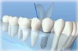 Caledonia Dental Implants