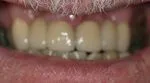 close up of man's smiling mouth after cosmetic dentistry transformed his brown teeth, dentist Adelaide, SA