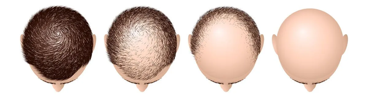 male hair loss treatment