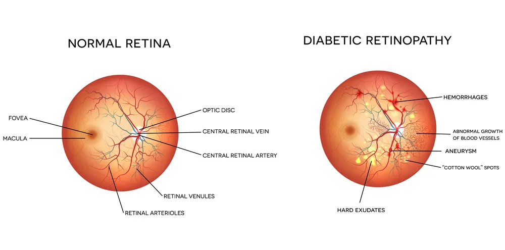 Diabetic Retinopathy	