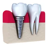 illustration of screwed in dental implant next to real tooth, Plain City, OH dental implants