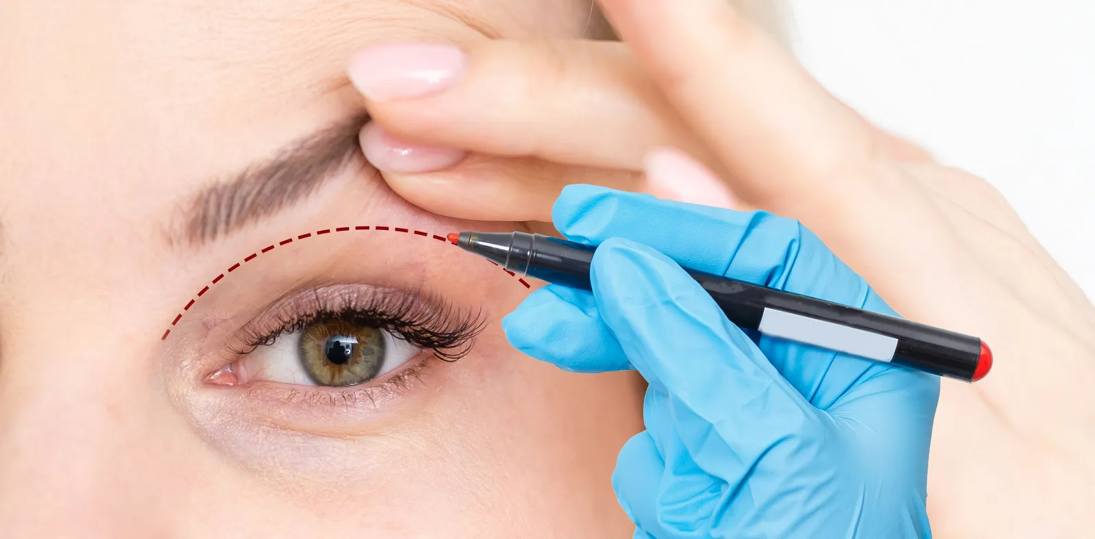 Eyelid Surgery FAQ