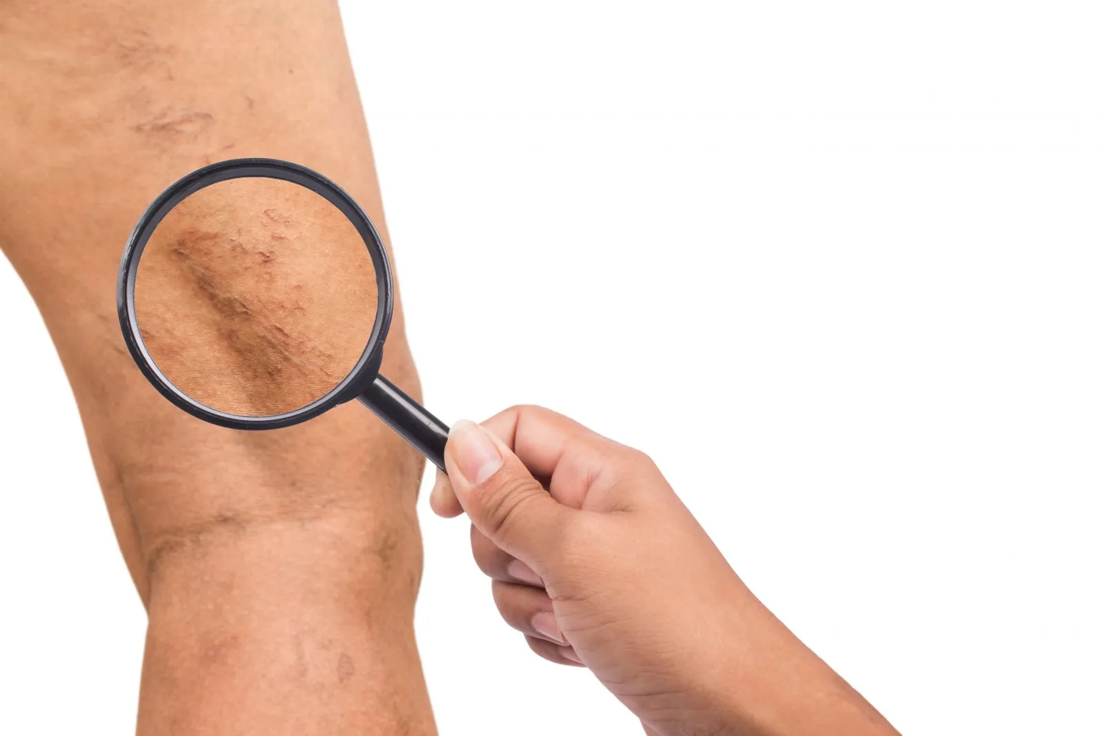 Varicose Veins, Sugar Land, TX