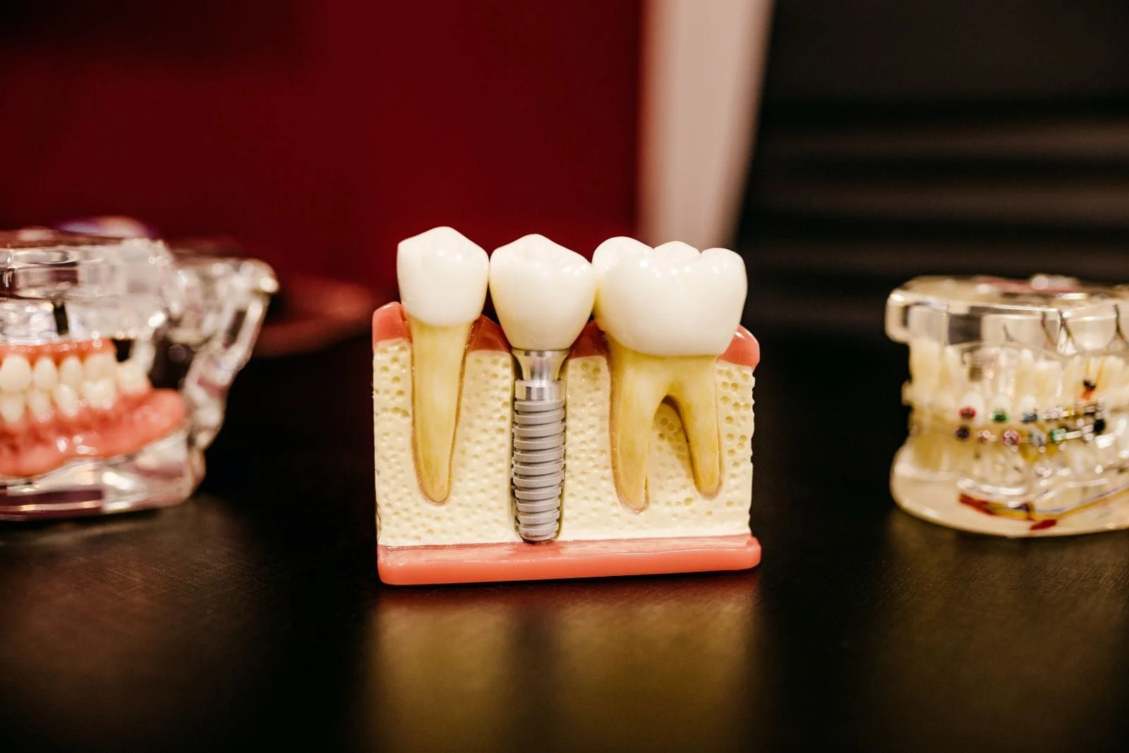 photograph of a model of a dental implant in a jaw
