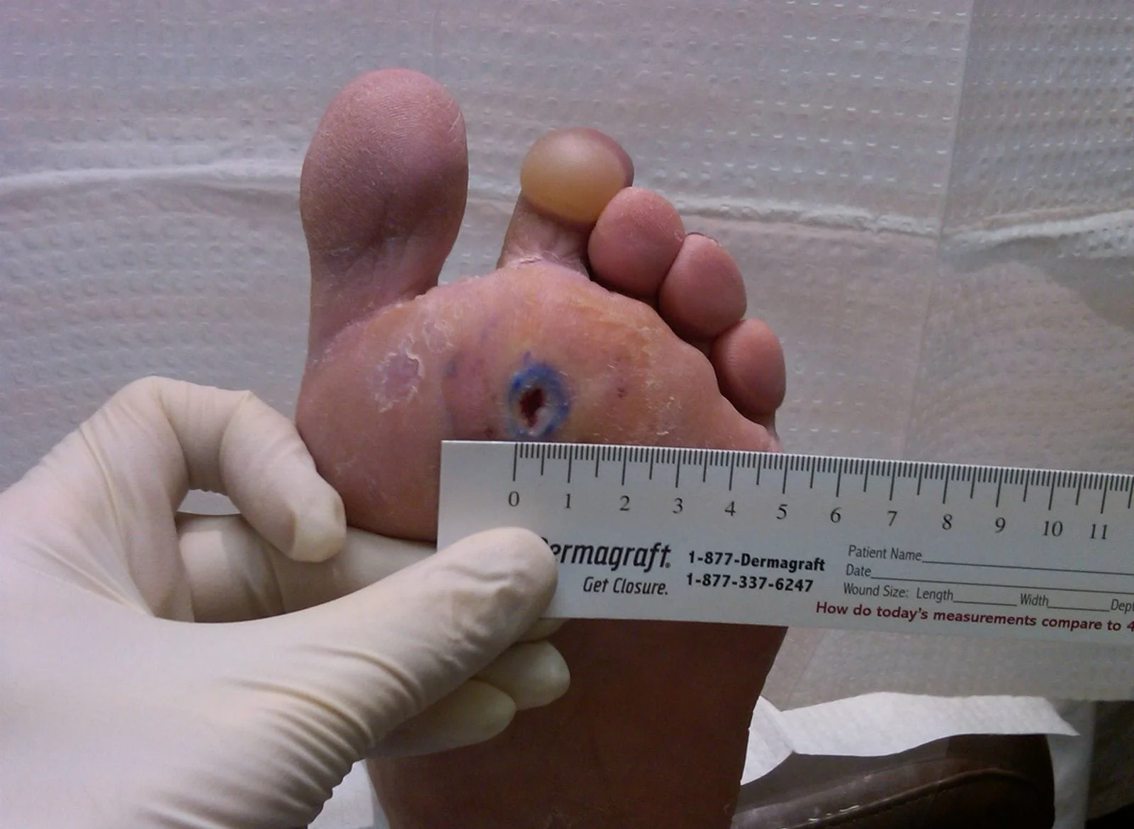 Diabetic Foot Ulcer healing after Dermagraft treatment
