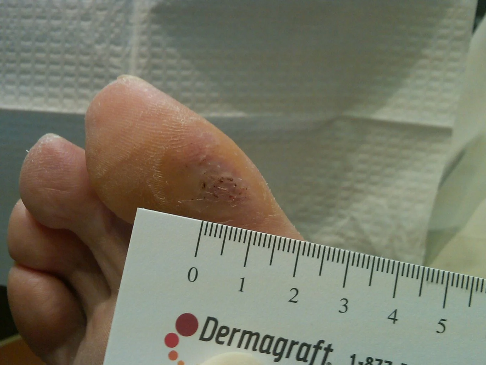 Toe Ulcer 3 Weeks After Dermagraft Treatment