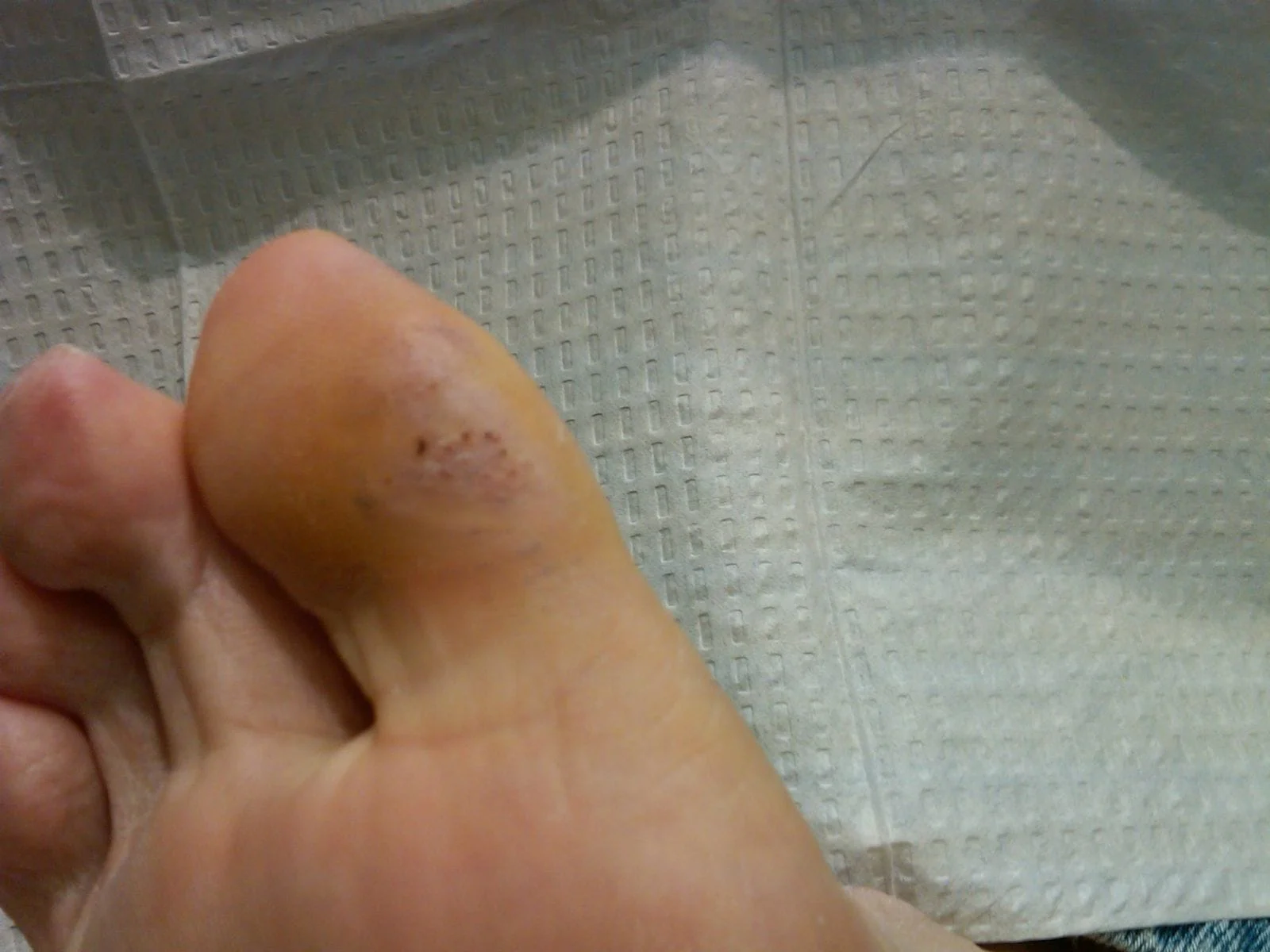 Toe Ulcer 4 Weeks After Only One Dermagraft Treatment