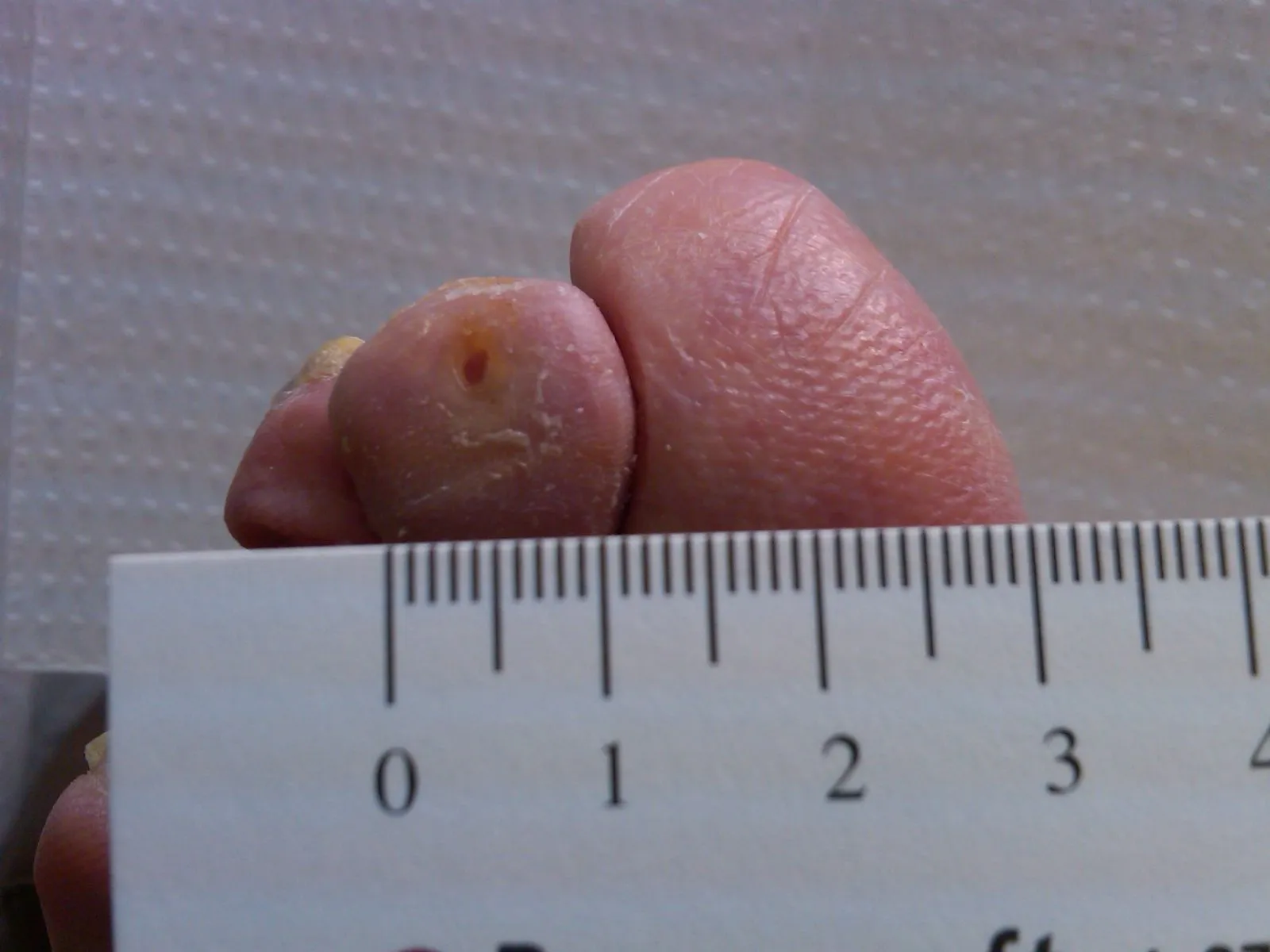 Diabetic ulcer on toe