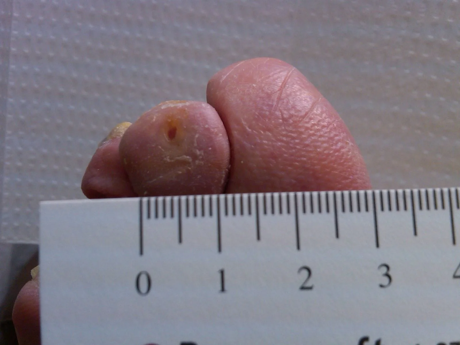 Diabetic ulcer on toe