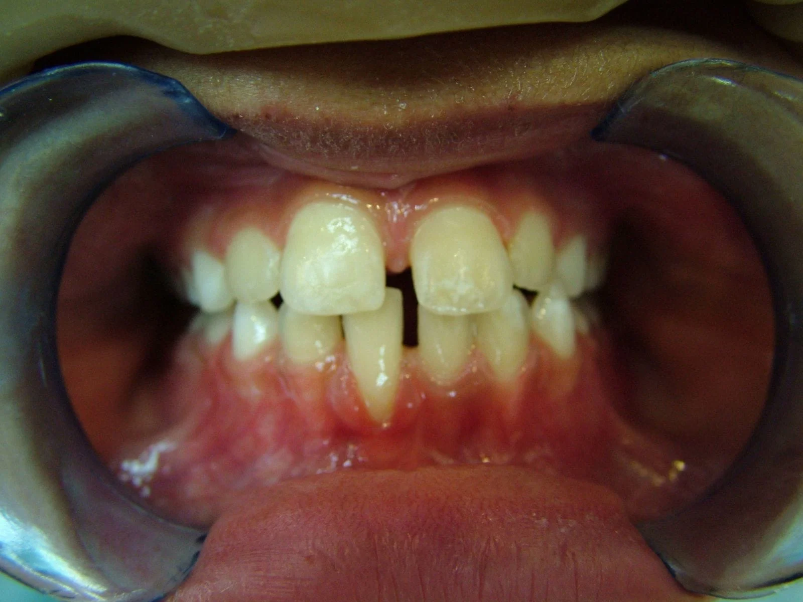image after treatment with early intervention orthodontics norfol ma
