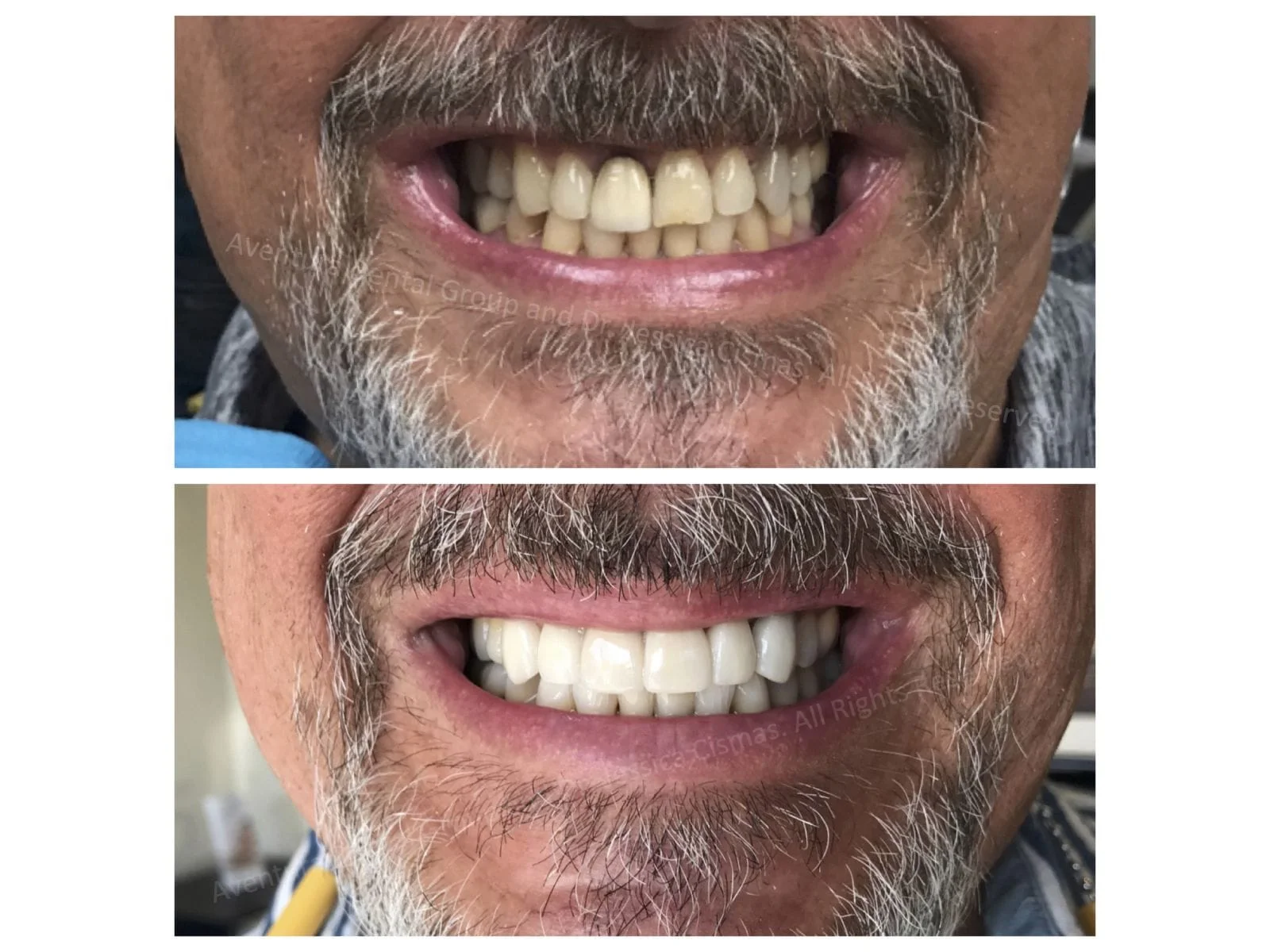 Dr. Jessica Cismas from Aventura Dental Group just completed another full mouth porcelain veneer case sucessfully. At Aventura Dental Group we pride ourselves with building amazing long lasting smiles for lifetime. If you need a second opinion consultation please DM us @aventuradentalgroup on Instagram.