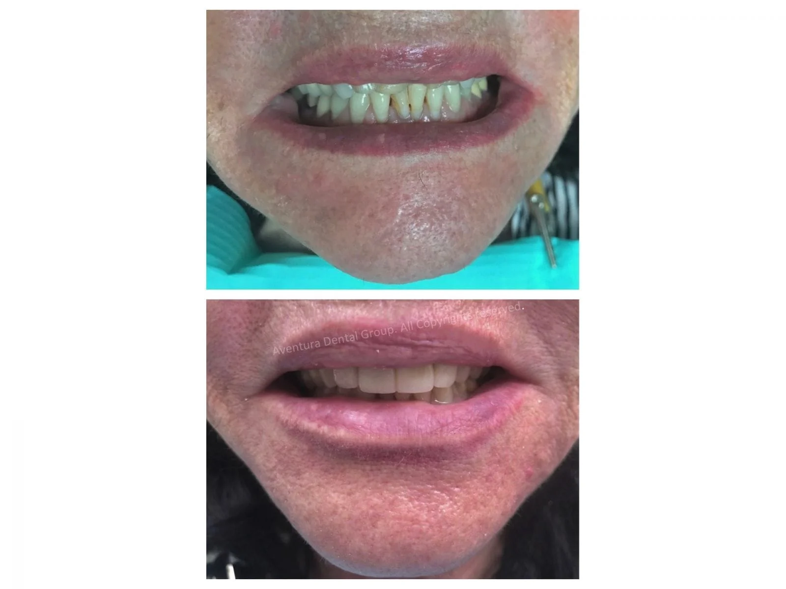 Aventura Dental Group is proud of another succesful full mouth restoration treatment. The patient came in and always wanted to see her upper teeth when smiling. We made that happen by raising her bite and give her the natural smile she wanted for a long time. The patient was very happy with the results. For a virtual aesthetic and cosmetic consultation with one of our award winning doctors DM us @aventuradentalgroup or call us at 305-935-4030.  Come and experience the difference in quality. We proudly serve the Aventura community since 1985. We are your local cosmetic dentist in Aventura, Florida. 