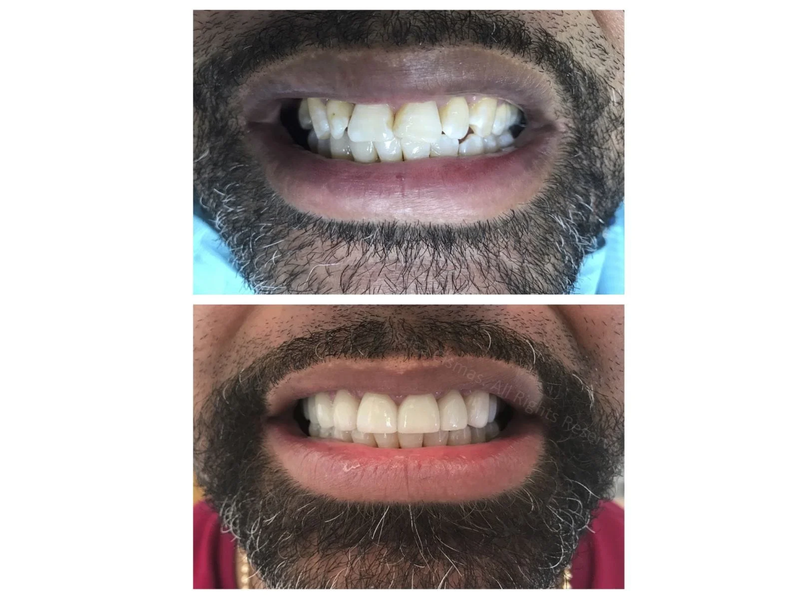 Porcelain veneers for this gentleman , makes all the difference. Dr. Jessica Cismas managed to create a unique look with natural looking porcelain veneers. For a limited time she offers complimentary consultations.