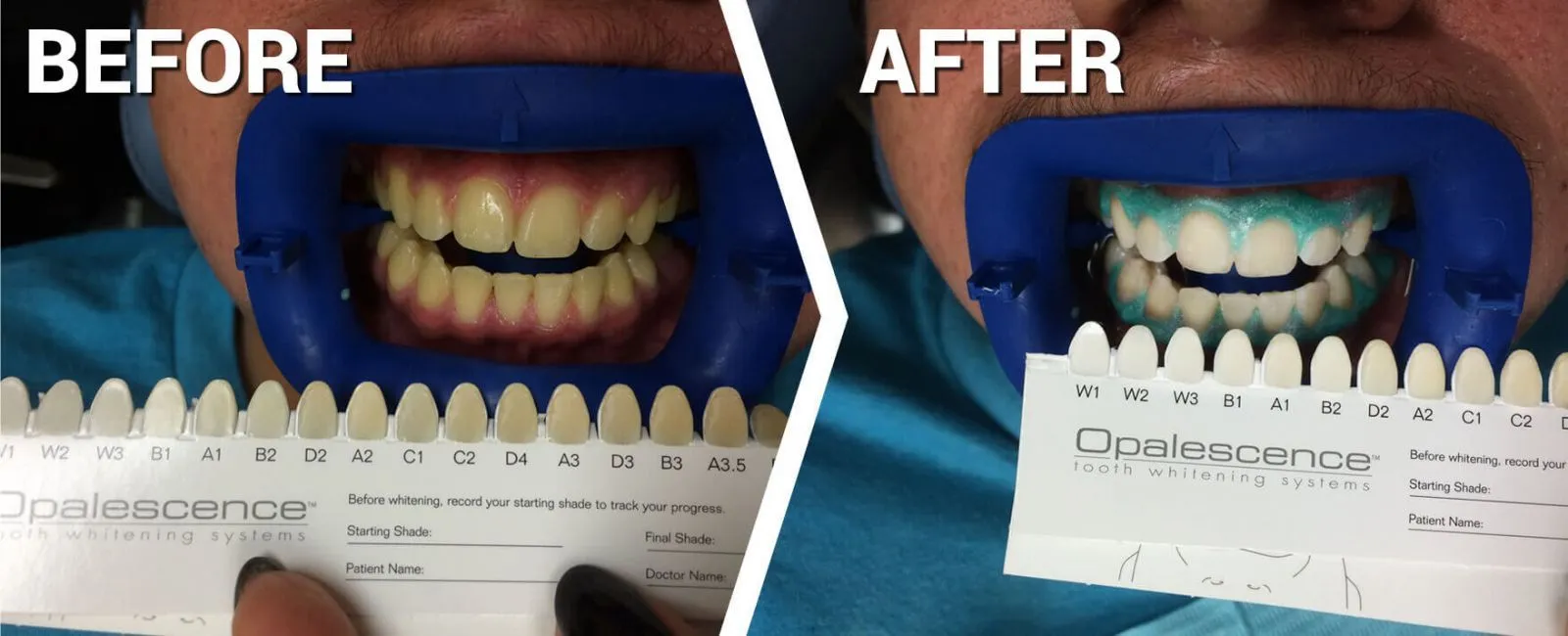 Teeth whitening promotion - before and after 