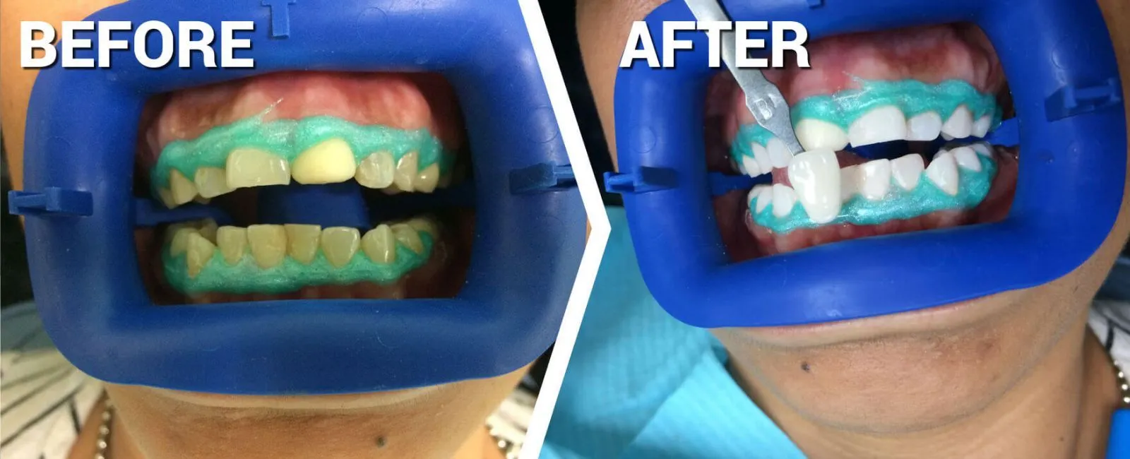 Teeth whitening promotion 