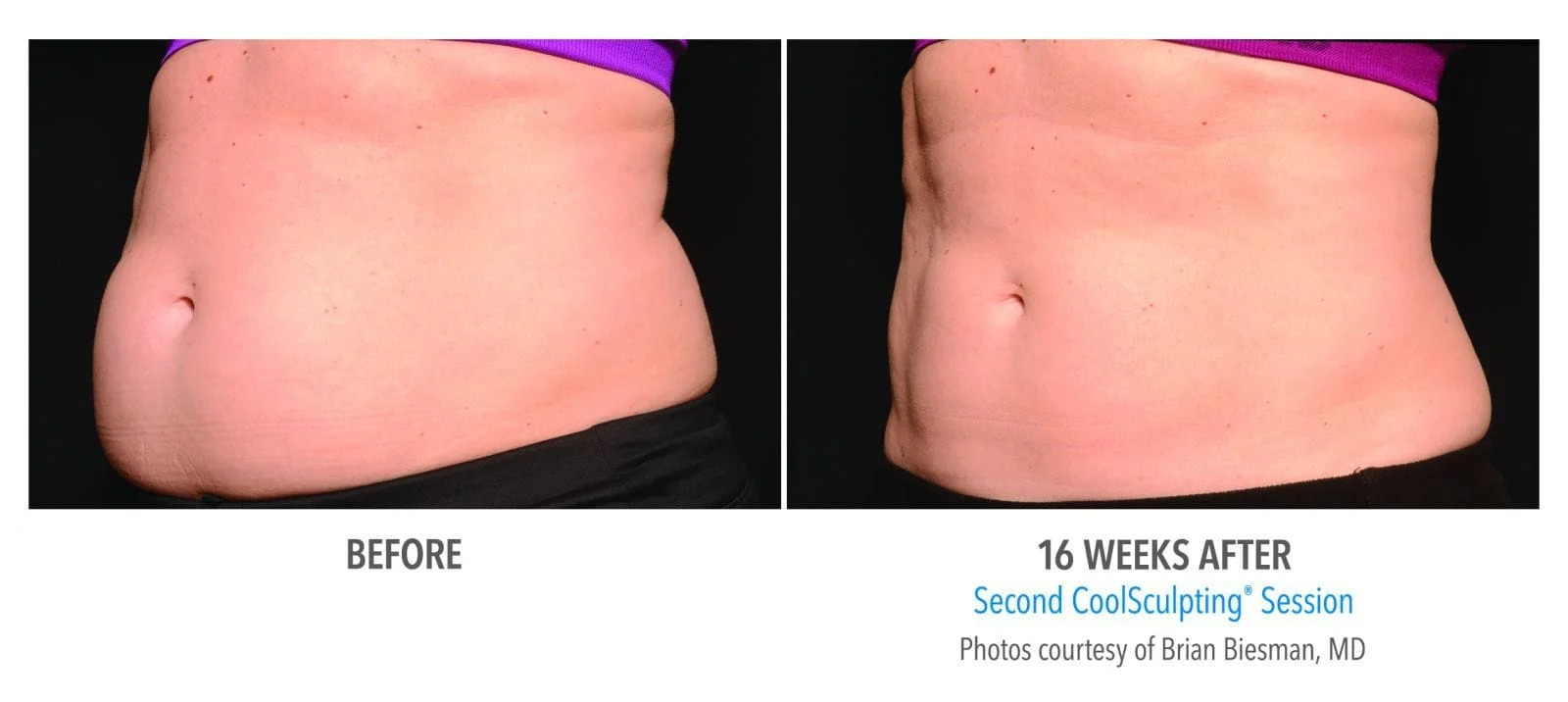 CoolSculpting: The Secret To Snapping Back After Baby