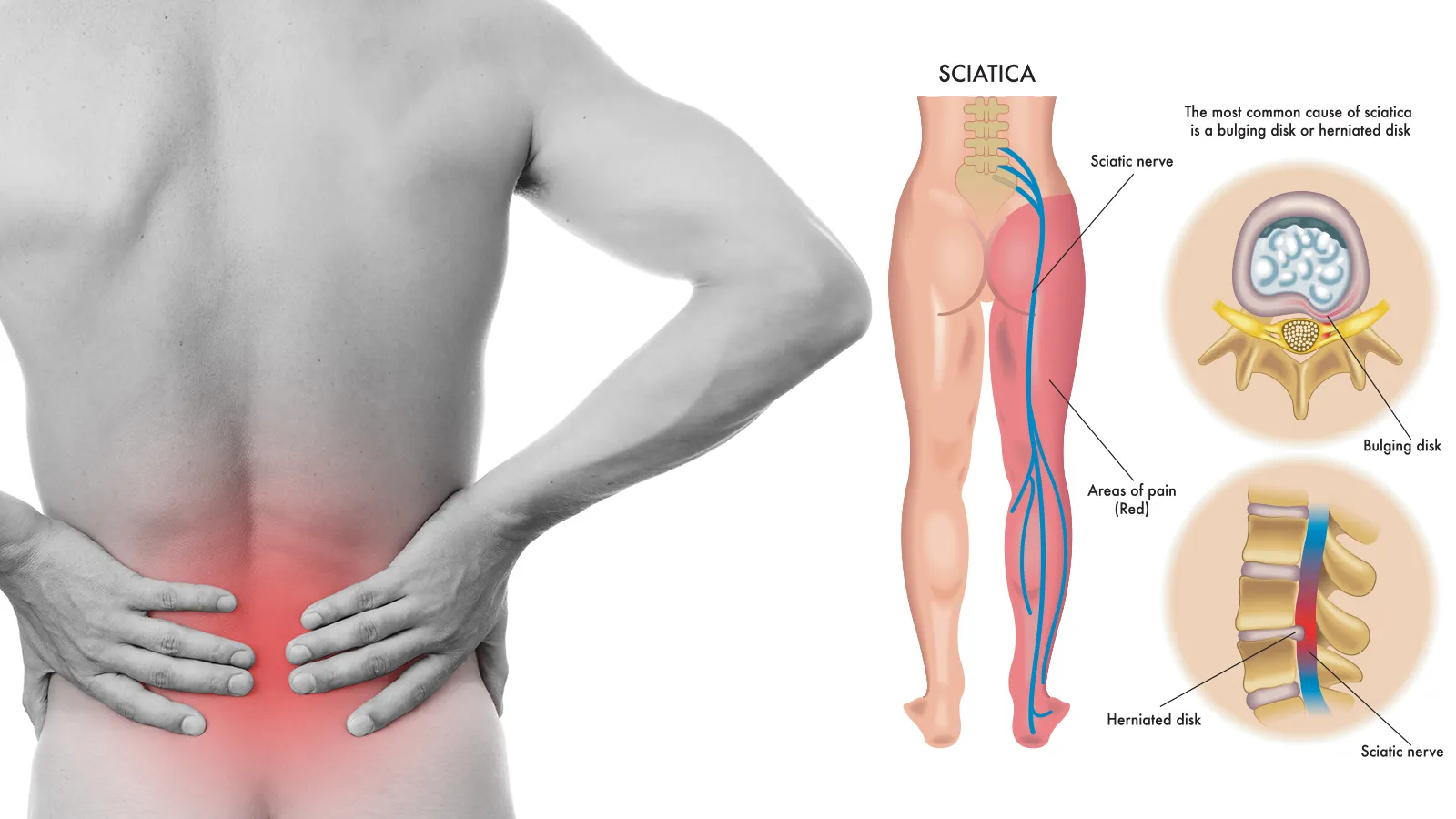 Sciatica Hip Pain Causes, Treatment Los Angeles, Beverly Hills, Santa  Monica CA
