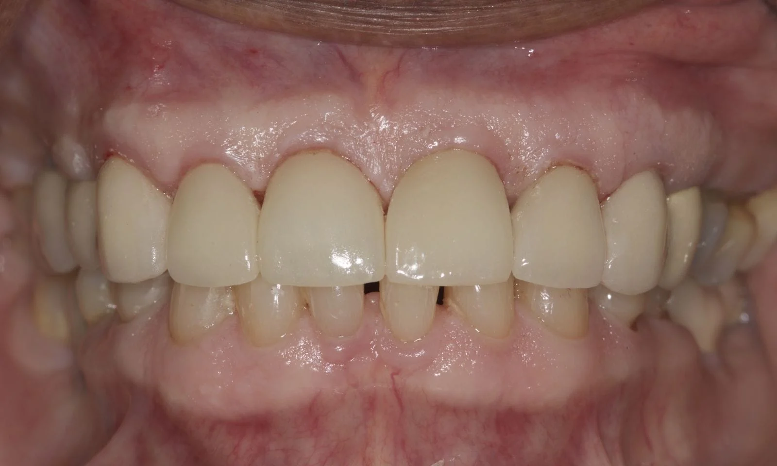 Front Teeth Crowns - After