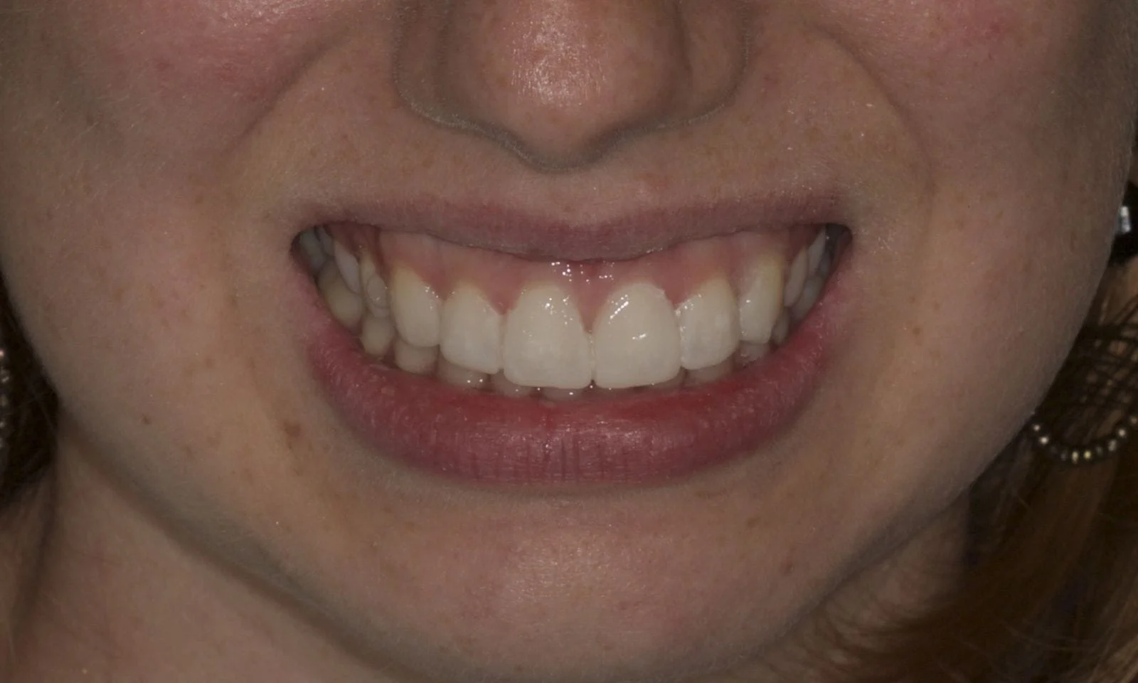 Dental Veneers - After